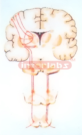 HANGING EXTRAPYRAMIDAL SYSTEM MODEL (CORPUS STRIATUM-GLOBUS PALLIDUS)